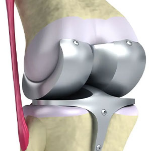 joint replacement